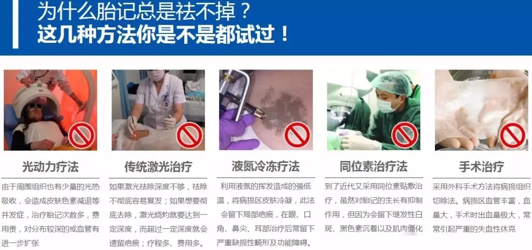 广州去胎记哪家医院技术比较好